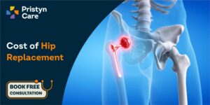 Cost of hip replacement