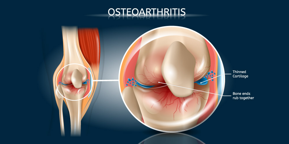 Osteoarthritis