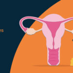 Ovarian-Cyst-Surgery-Cost