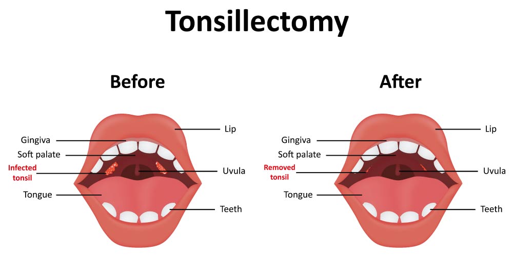 Before & After -Tonsillectomy Surgery