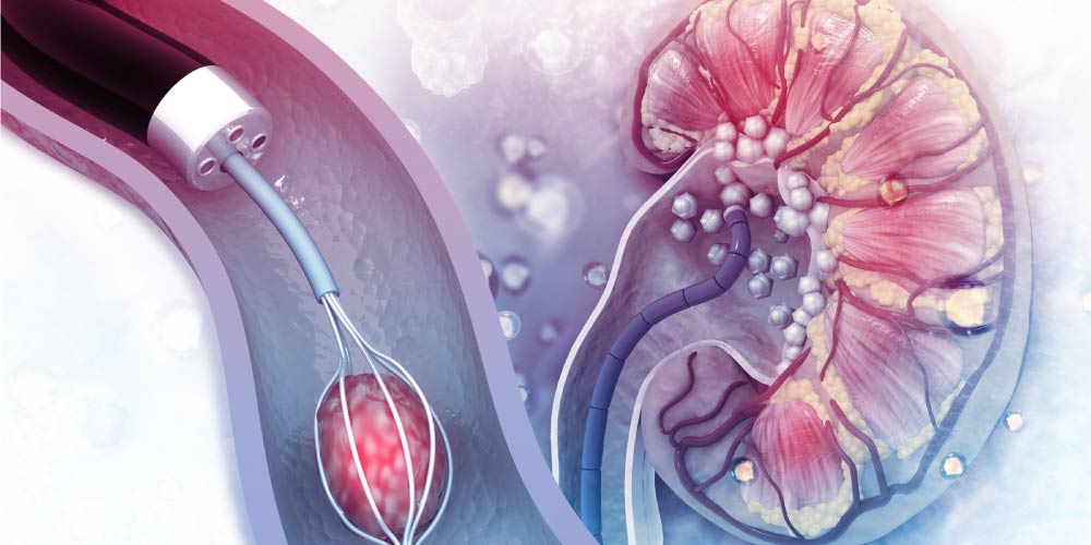 ¿Qué Son Los Cálculos Renales? Causas, Síntomas, Diagnóstico, Tratamiento Y Prevención 7 Litotricia ureteroscópica
