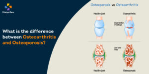 What-is-the-difference-between-Osteoarthritis-and-Osteoporosis