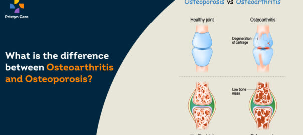 What Is The Difference Between Osteoporosis And Osteoarthritis?