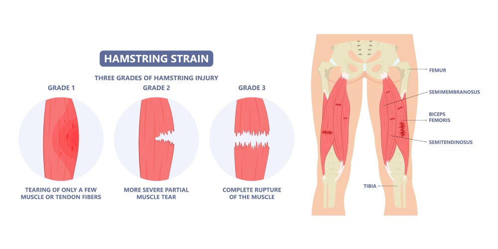 Hamstring Strain