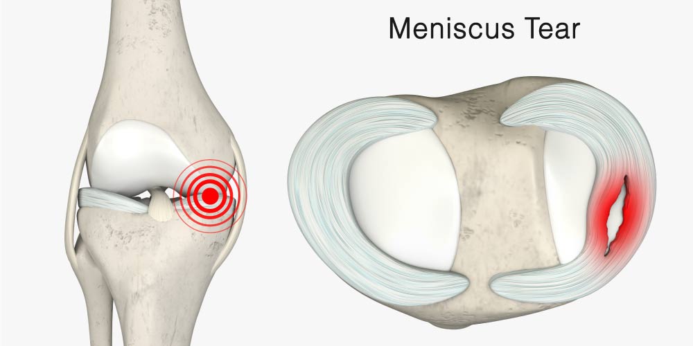 Torn meniscus - Meniscus Tear