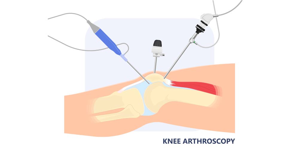 Knee Arthroscopy