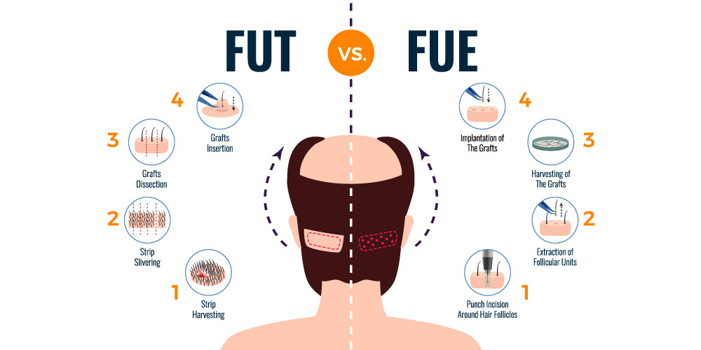 hair transplant techniques