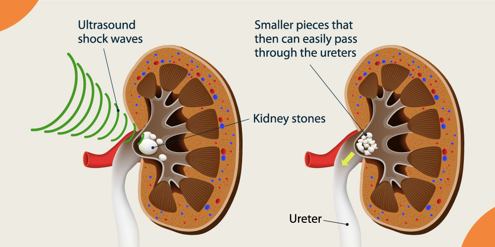 Extracorporeal Shock Wave Lithotripsy (ESWL) Purpose, Procedure, and