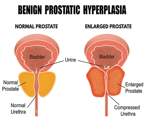 Benign Prostatic Hyperplasia(BPH)
