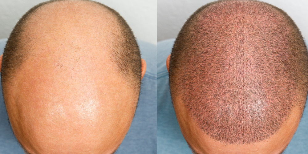 What happens in hair transplantation