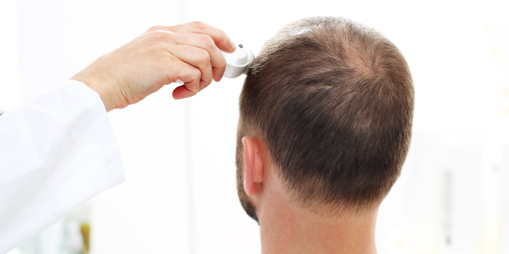 Follicle grafts before hair transplantation