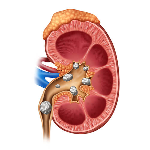 KIDNEY STONE