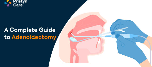 A Complete Guide For Adenoidectomy