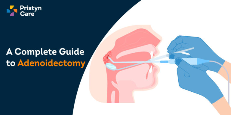 A-Complete-Guide-to-Adenoidectomy