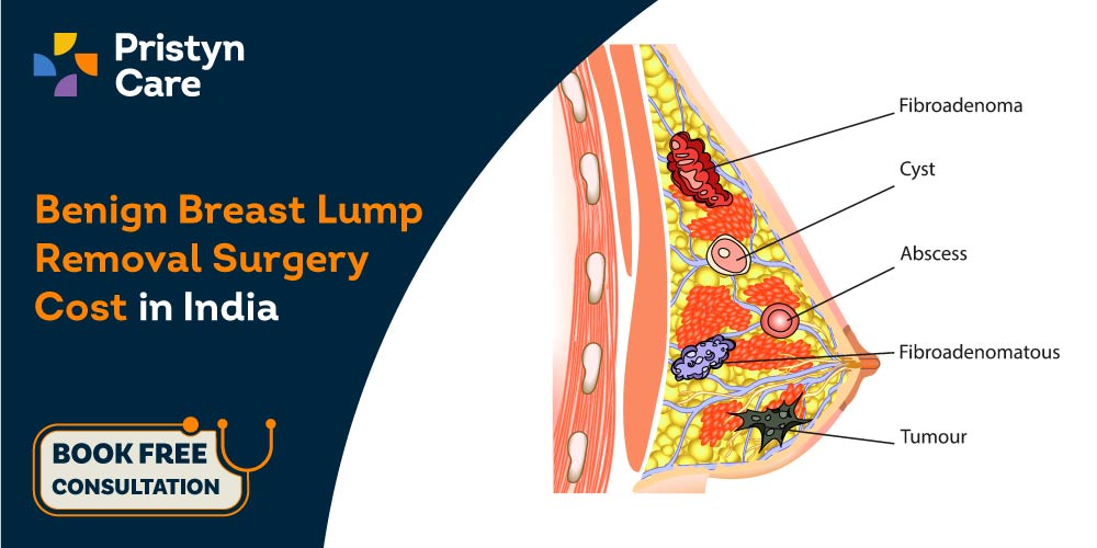 benign breast lump removal surgery cost