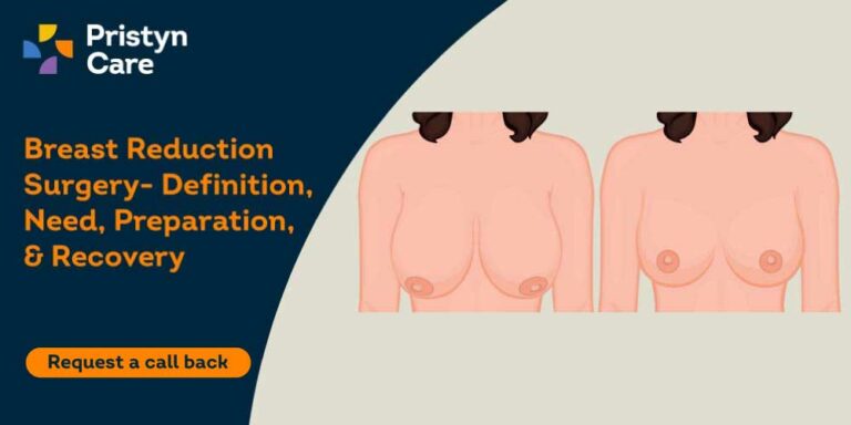 Breast-Reduction-Surgery--Definition,-Need,-Preparation,-&-Recovery