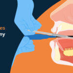 How-Much-Does-Adenoidectomy-Surgery-Cost