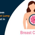 How Much Does Benign Breast Lump Removal Cost in Gwalior