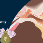 Cost-of-stapedectomy-in-India