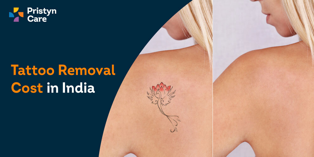Laser Tattoo Removal in Delhi Permanent Tattoo Removal South Delhi