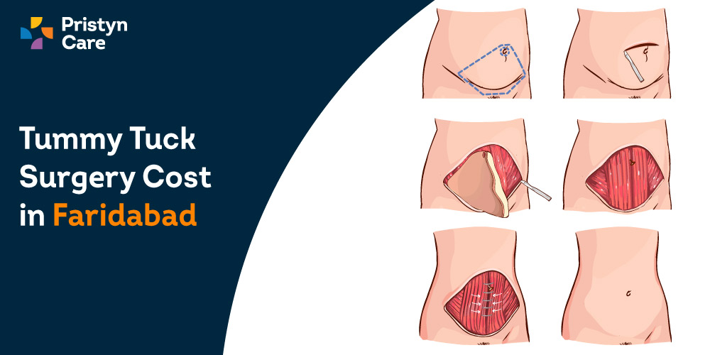 Tummy-Tuck-Surgery-Cost-in-Faridabad