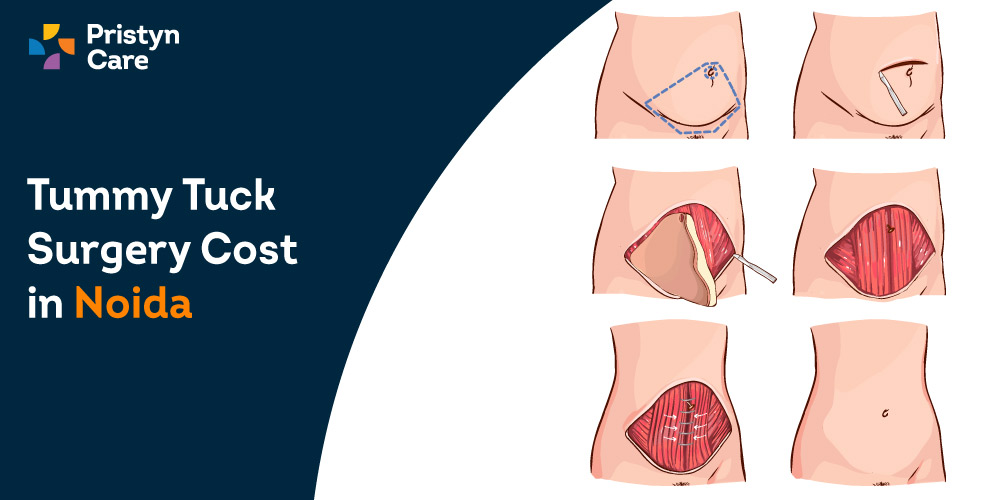 Tummy-Tuck-Surgery-Cost-in-Noida