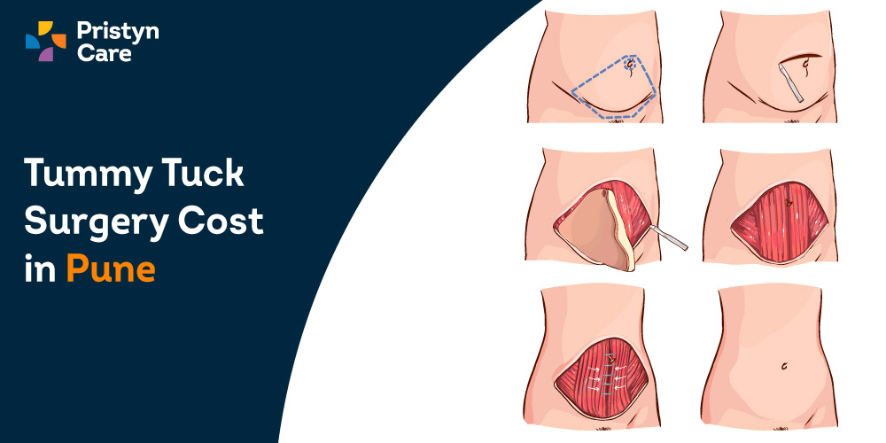 How Much Does Tummy Tuck Surgery Cost in Pune?