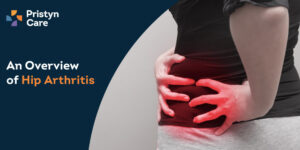Hip Arthritis - Causes, Symptoms, and Treatment