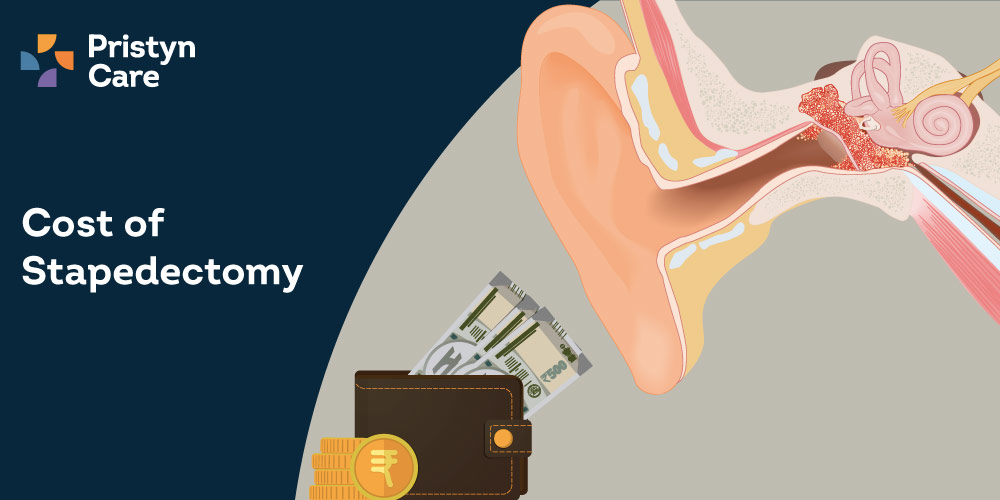 Cost-of-stapedectomy