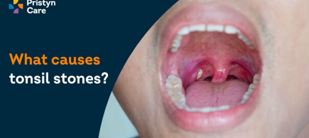 What causes tonsil stones?