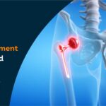 Hip replacement cost in Hyderabad