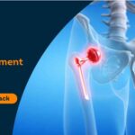 Cost of hip replacement in Mumbai