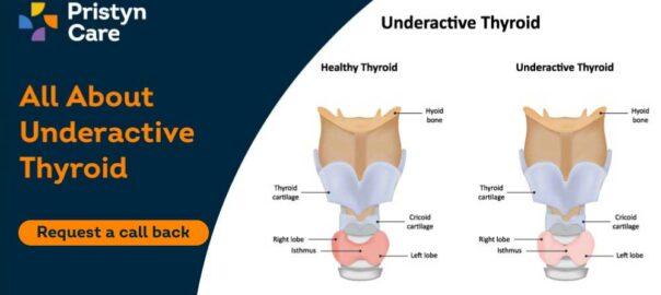 Underactive Thyroid (Hypothyroidism)