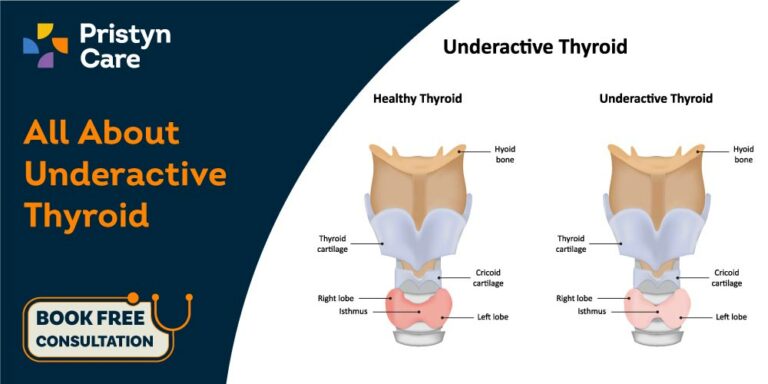Hypothyroidism - Underactive Thyroid