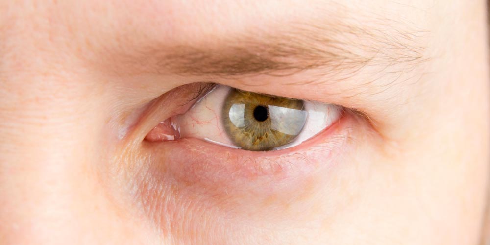 man having droopy eyelids, caused due to cataract