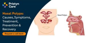 Nasal-Polyps-Causes,-Symptoms,-Treatment,-Prevention-&-Recovery