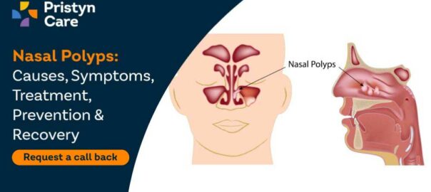 Nasal Polyps: Causes, Symptoms, Treatment, Prevention & Recovery