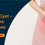Ovarian Cyst Symptoms and Causes