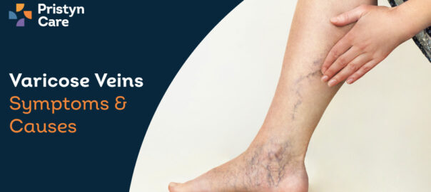 Varicose Veins Symptoms and Causes