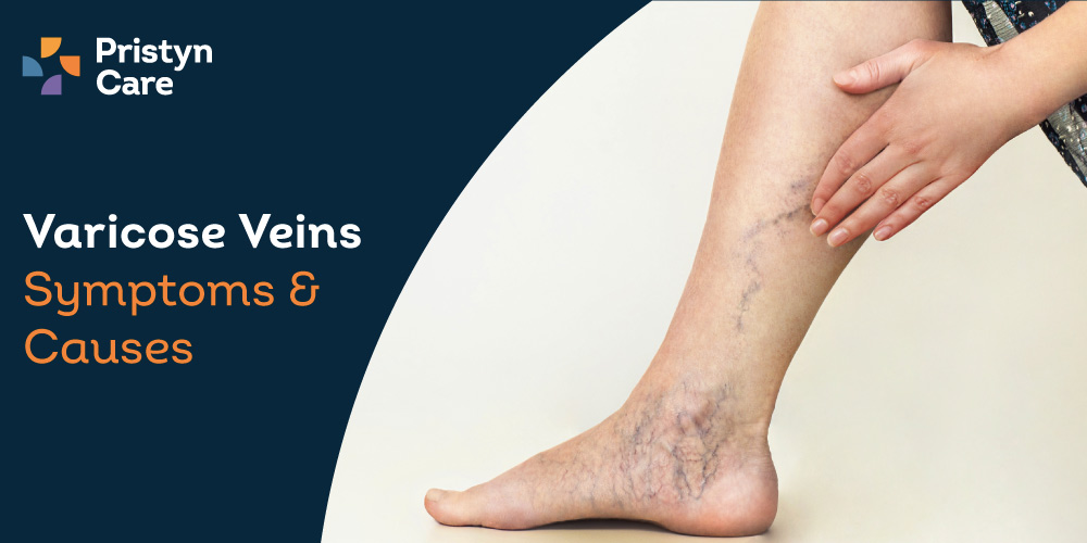 Varicose Veins Symptoms & Treatment