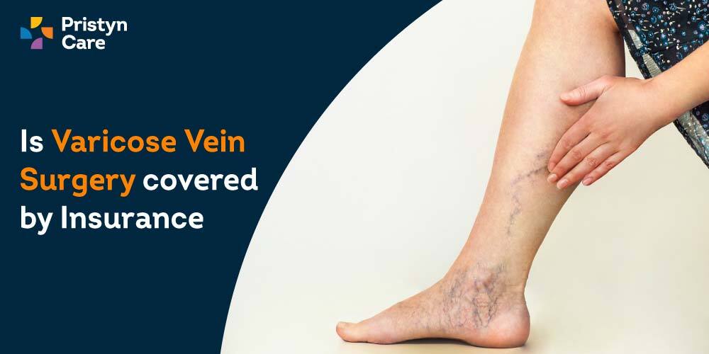 Insurance Coverage for Varicose Vein Surgery