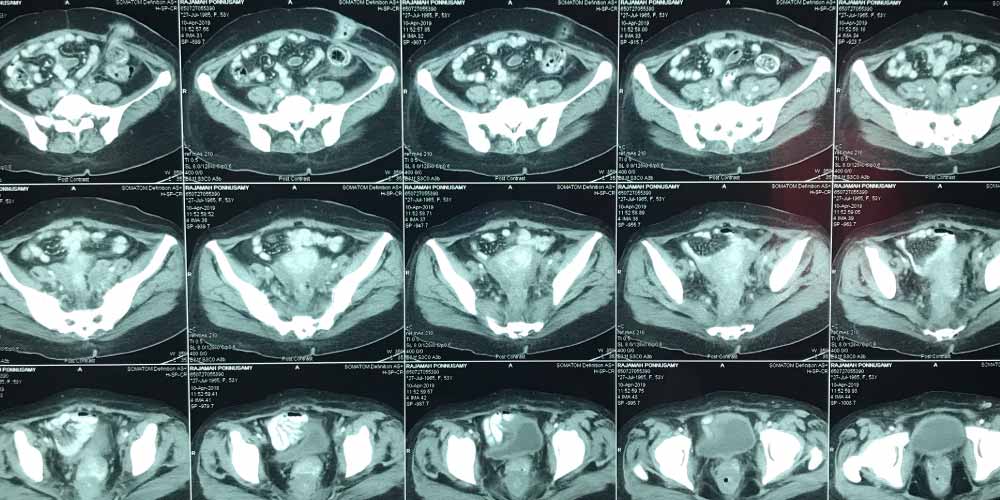 MRI For Different Fistula Treatment