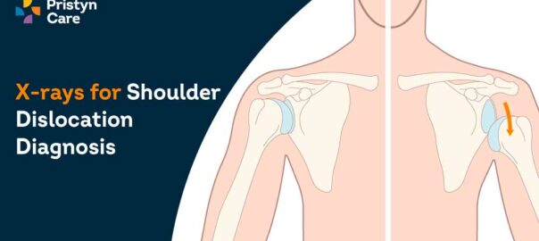 X-Ray to Diagnose Shoulder Dislocation