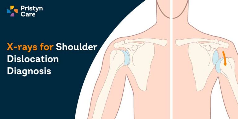 X-Ray to Diagnose Shoulder Dislocation