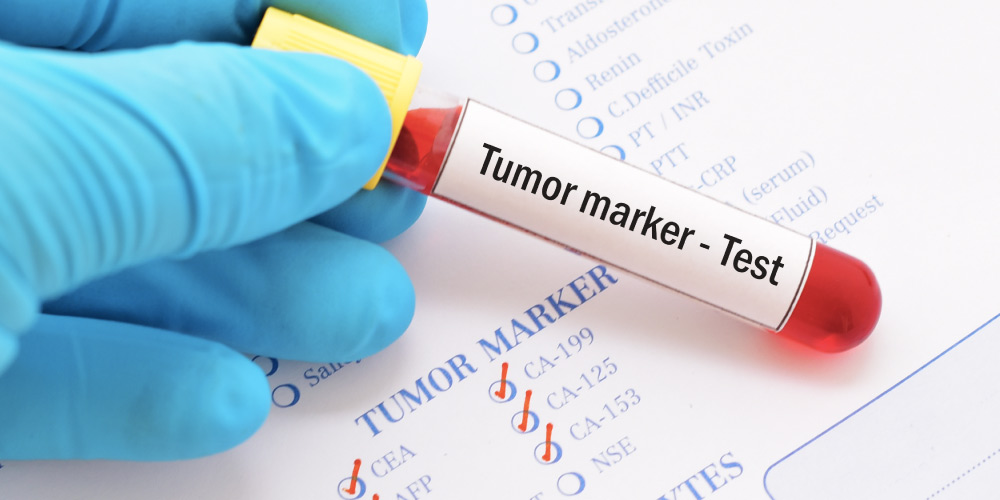 CA 125 Blood test for ovarian cyst