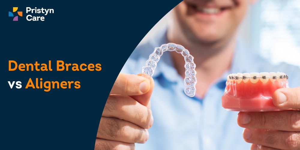 dental braces vs aligners