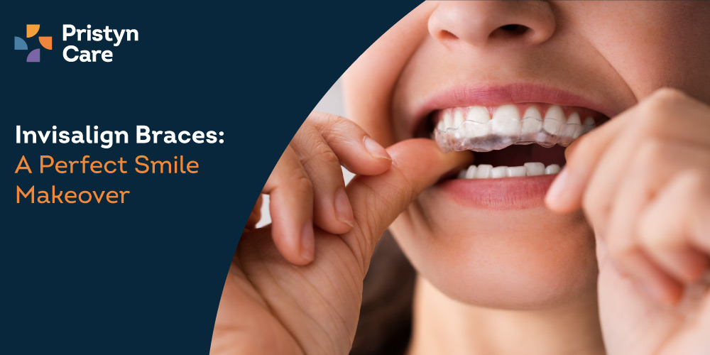 Invisalign Braces- A Perfect Smile Makeover