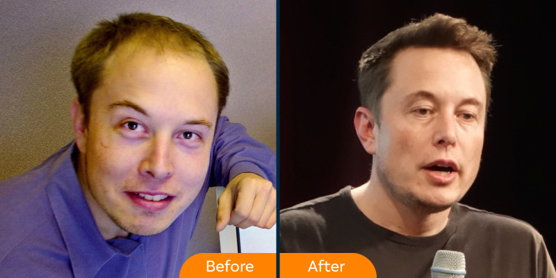 Elon musk hair transplant