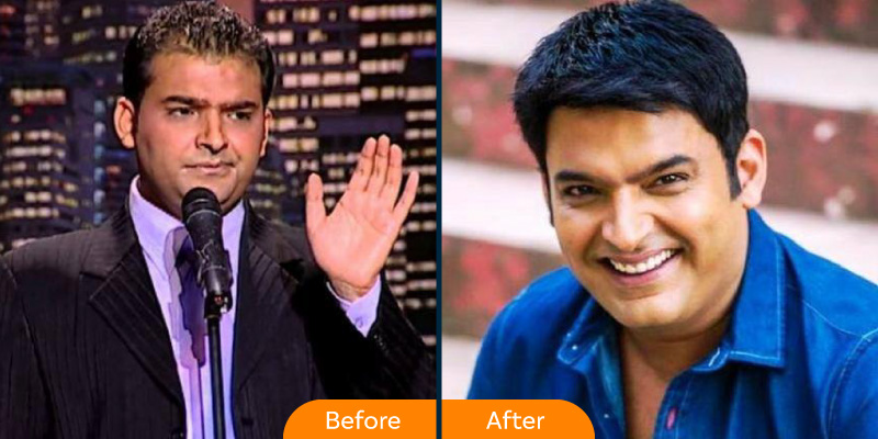 Kapil Sharma hair transplant 