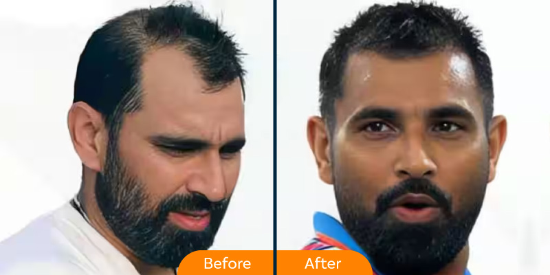 Mohammad Shami hair transplant